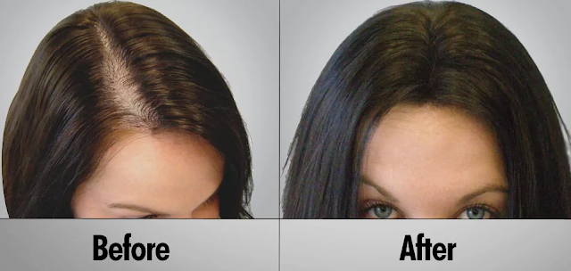 Hair Transplant Treatment in Delhi