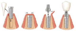 Cấy ghép răng implant-1