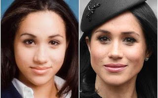 Meghan Markle's nose, in high demand in cosmetic surgery