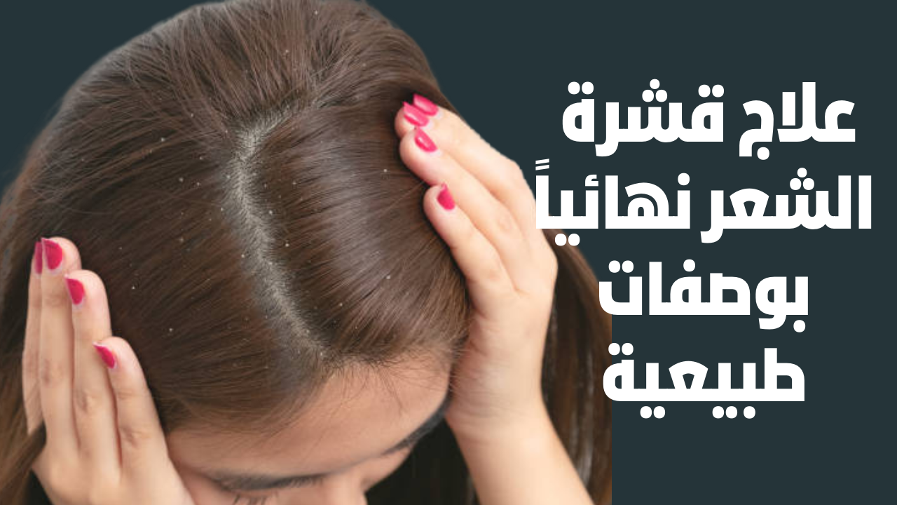 علاج قشرة الشعر نهائياً والتخلص منها بطريقة دائمة