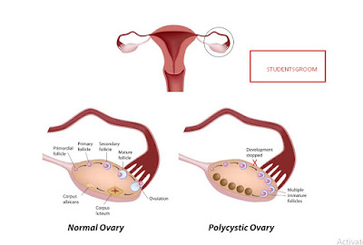 oophorectomy