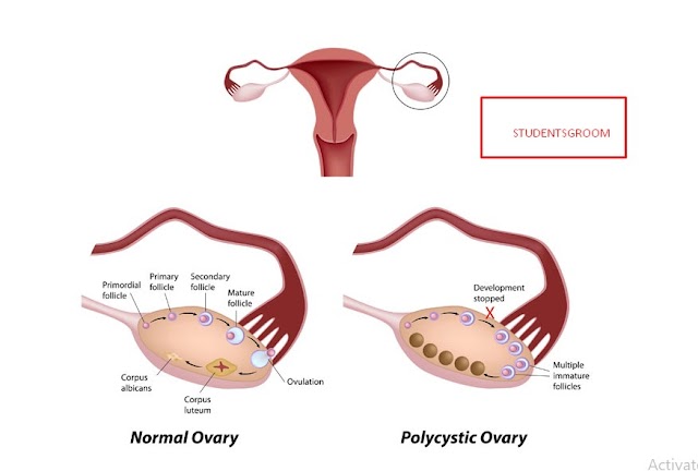 Bilateral oophorectomy may raise a woman's dementia risk