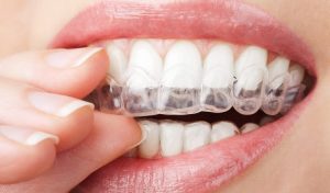 Đặc điểm của các loại niềng răng-3