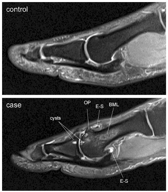 First metatarsophalangeal joint osteoarthritis treatment