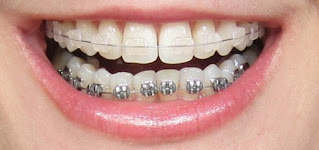 Các phương pháp niềng răng chỉnh móm
