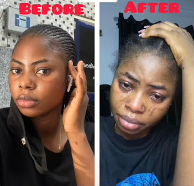 Video: botched surgery leaves beautiful lady with more scars after she underwent laser treatment to remove her tribal mark