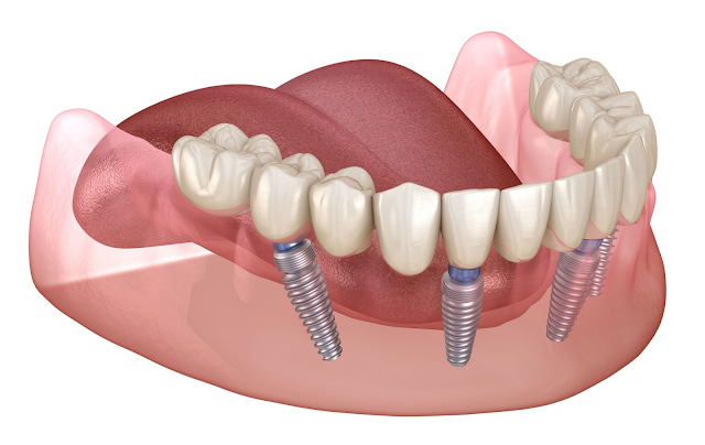 All On Four dental implant
