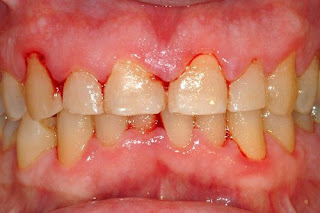 Quy trình cạo vôi răng tại nha khoa-2
