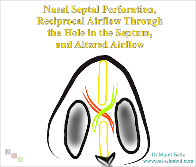 Nasal Septal Perforation, Reciprocal Airflow Through the Hole in the Septum, and Altered Airflow