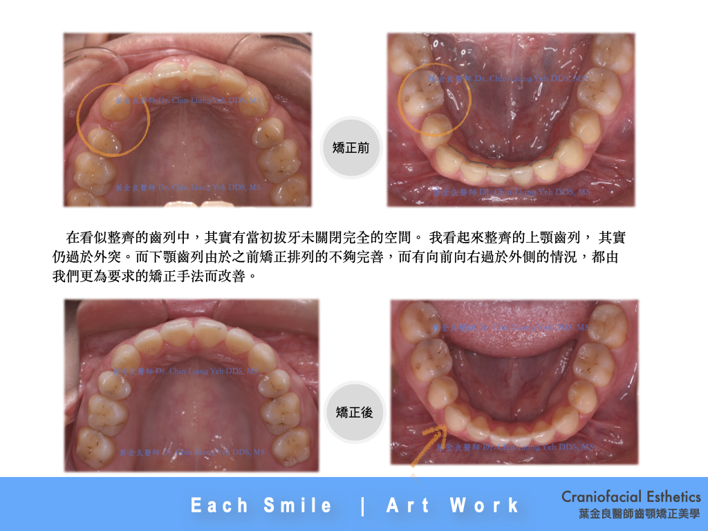 非正顎手術方法解決骨性歪斜  Skeletal Asymme