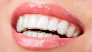 Quy trình niềng răng invisalign-3