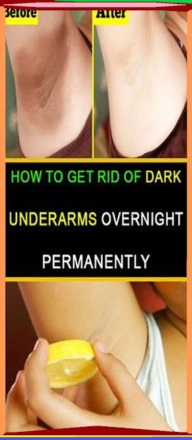 How to Get Rid of Dark Underarms Overnight Permanently