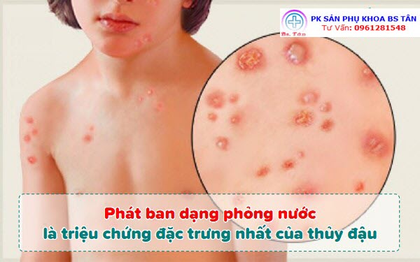 Điều Trị Thuỷ Đậu Cho Trẻ Tại Nhà