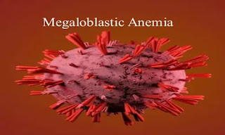 Megaloblastic Anemia