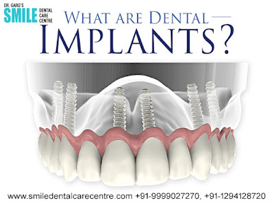 Best Dental Implant Clinic in Faridabad