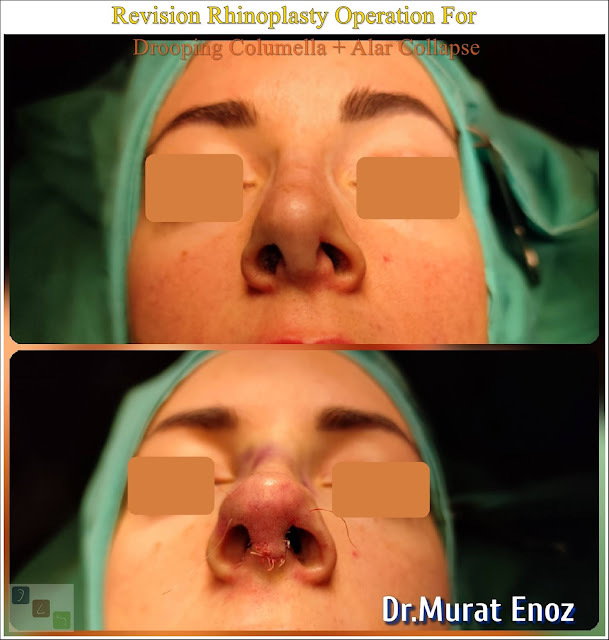 Drooping Columella,Hanging Columella,Revision rhinoplasty in women,Secondary nose job,Alar Collapse After Nose Aesthetic Surgery,