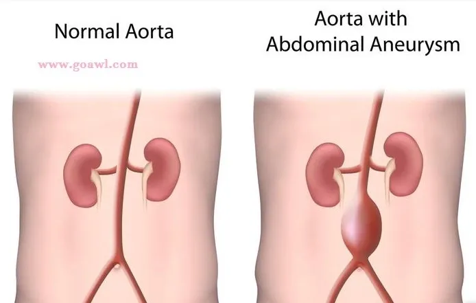 Abdominal aortic aneurysm is there a way to prevent complications of the deadly disease