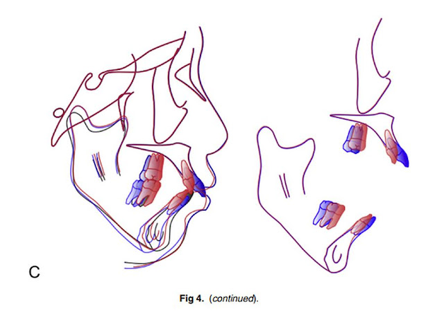 PDF: Protocols for orthodontic treatment of patients with temporomandibular joint disorders