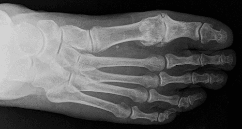 1st metatarsophalangeal joint osteoarthritis icd 10 a kézízületek néha fájnak