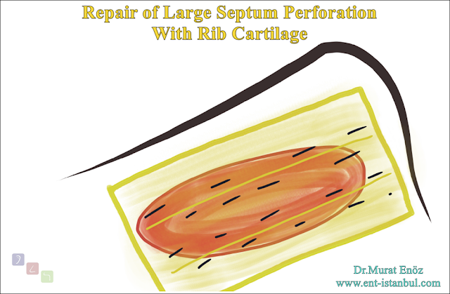 Nasal septum perforation rapairing surgery,Closure of nasal septum perforation with rib cartilage,Treatment of large septal perforation,Repair of nasal septum perforation with rib cartilage,