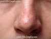 Painful Blind Pimple On Nose - Causes, Treatments And  Prevention.