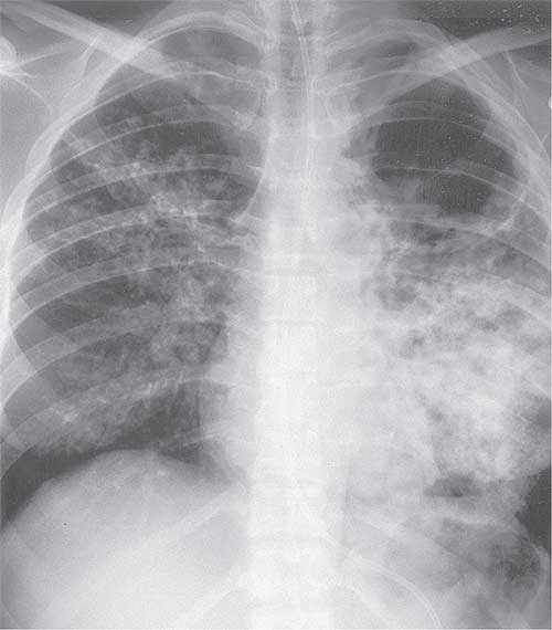 Chest x-ray Pulmonary Diseases and Disorders