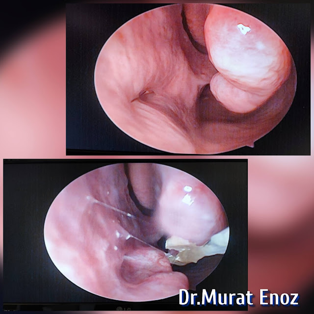 Cartilage Implanting To The Inferior Meatus For Nasal Hyperventilation - Inferior Meatus Augmentation With Rib Cartilage Procedure