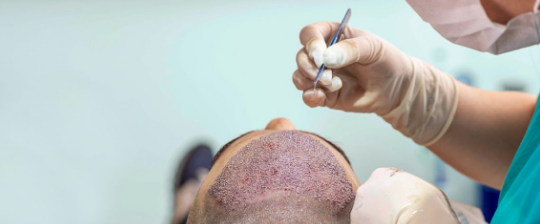 A 30-year-old man dies after hair transplant goes wrong 