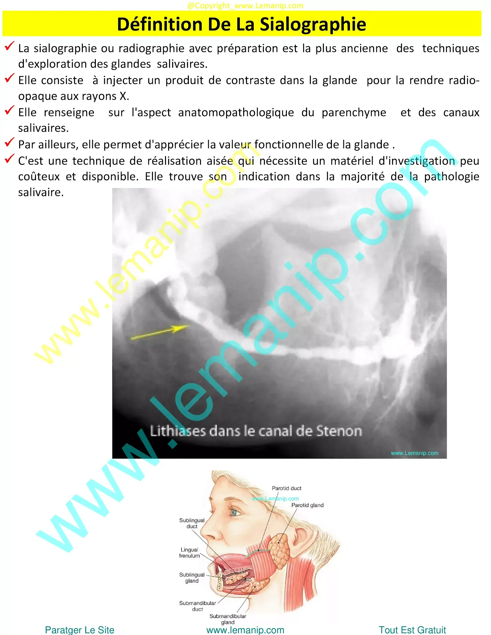 removing salivary gland,sjogren's swollen glands,left parotid,parotid duct,stensen's duct,parotid gland duct,swollen parotid glands both sides,swollen parotid gland on both sides,superficial parotid,inflamed salivary gland