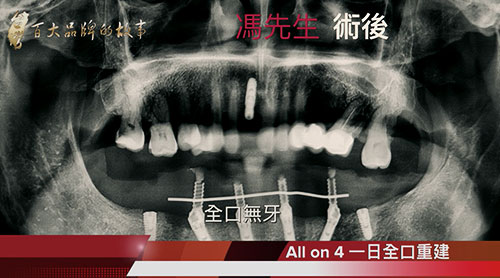 All-On-4/6一日全口重建植牙-成功案例-廖朝民醫師醫療團隊/愛菲爾植牙美學醫學中心/愛菲爾牙醫診所