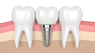 Bảng giá trồng răng implant mới nhất-2