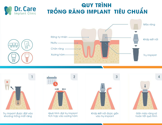 Quy trình trồng răng Implant gồm mấy bước? Vì sao cần phải tuân thủ quy trình