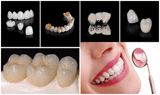 Trồng răng implant cho răng cửa-2
