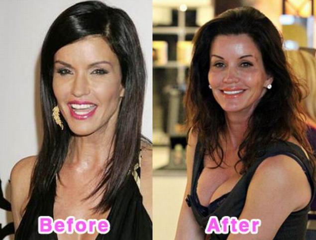 These are Hollywood celebrity's worst plastic surgery disasters