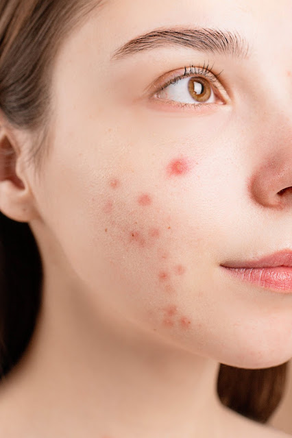 How do I Removal acne scars?