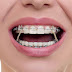 Niềng răng có thể hôn được không