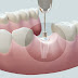  Quy trình cấy ghép răng implant