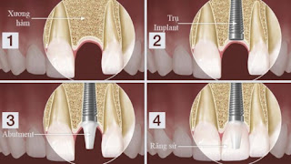 Răng implant là gì-2