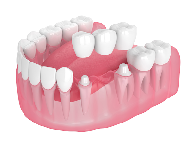 Dental Implants vs Bridges