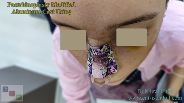 Modified Aluminum Cast, Postrhinoplasty Cast Using,Effect of postrhinoplasty taping on swelling in patients with thick skinned nose,Nostril Retainer,