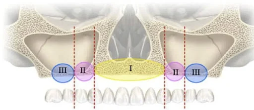 Bedrossian classification for pre-treatment approach and treatment of atrophic maxilla