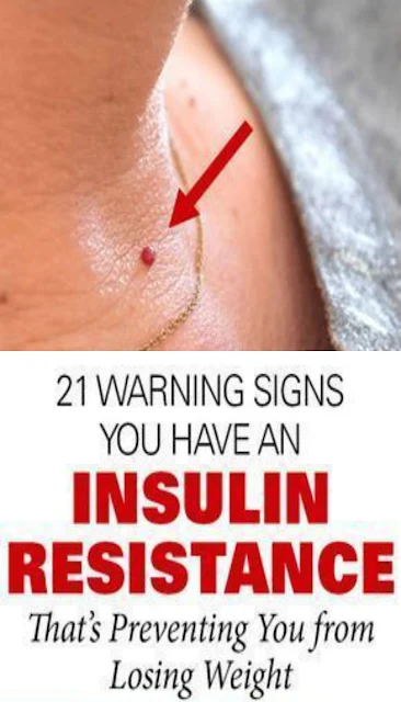 21 Warning Signs You Have An Insulin Resistance That’s Preventing You From Losing Weight