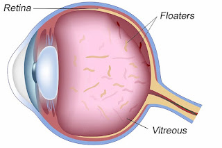 Eye Floaters