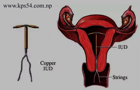 Vd. Vasectomy
