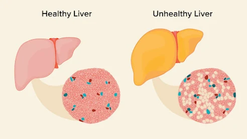 Early Signs that You Have a Fatty Liver