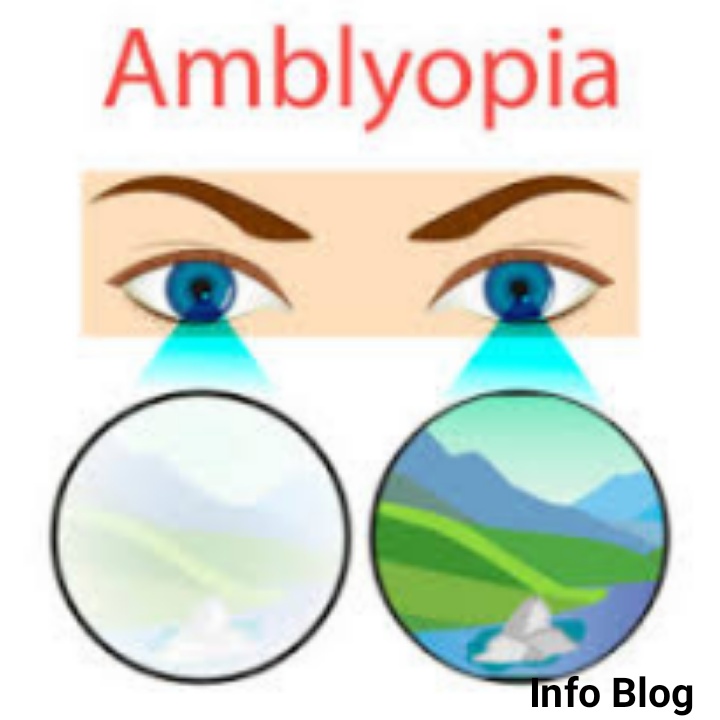 Refractive amblyopia