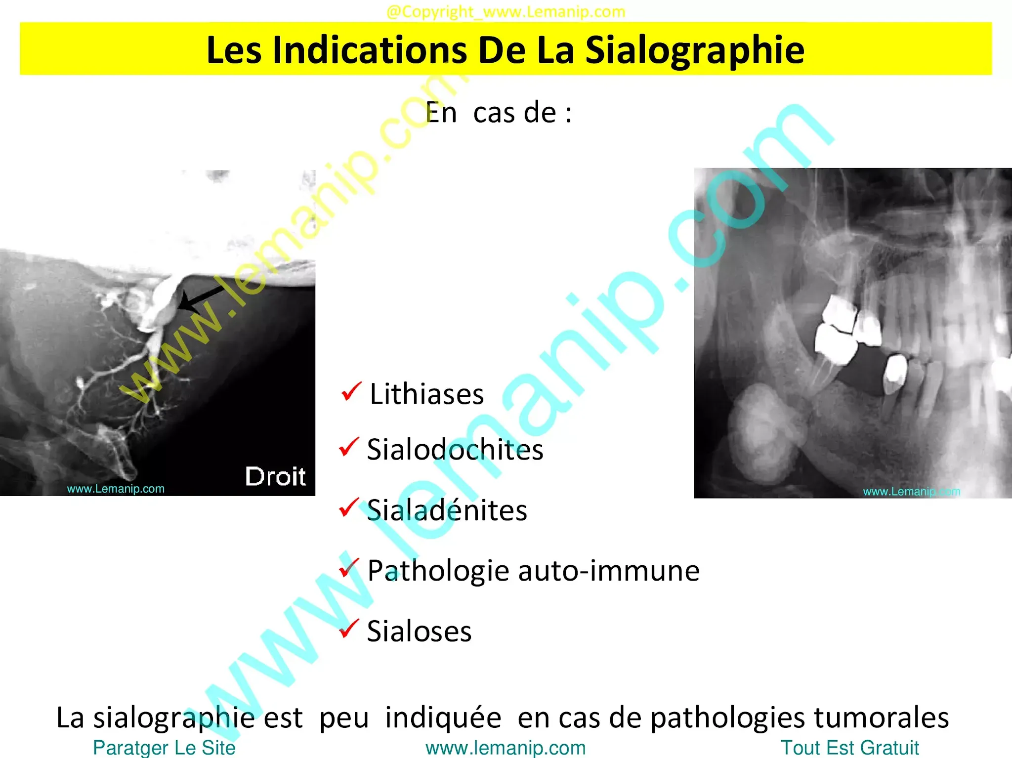 removing salivary gland,sjogren's swollen glands,left parotid,parotid duct,stensen's duct,parotid gland duct,swollen parotid glands both sides,swollen parotid gland on both sides,superficial parotid,inflamed salivary gland