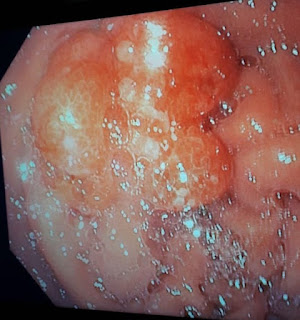 near focus of the polyp