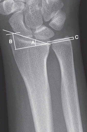 Distal Radius (Colles) Fracture