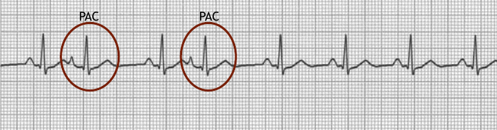 prematüre-atriyal-kompleks-ekg-degerlendirme-2